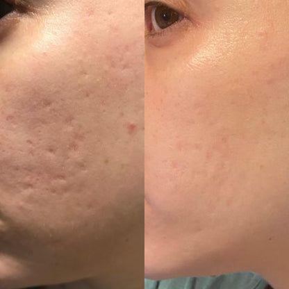 Solazis®-Hydrokolloid Rolle für Akne & Narben